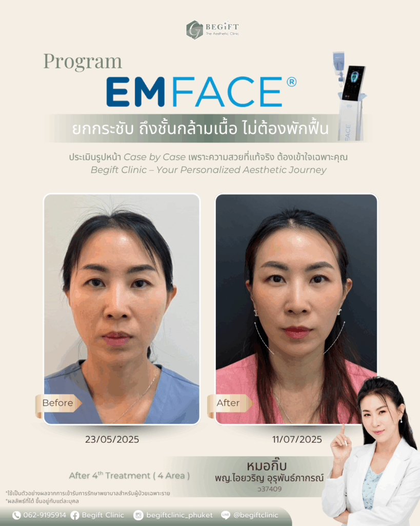 Emface นวัตกรรมยกกระชับใบหน้าใหม่ล่าสุดที่แรกที่เดียวในภูเก็ต ช่วยยกกระชับใบหน้า ลดริ้วรอย EMFACE เข้าไปกระตุ้นการทำงานของชั้นกล้ามเนื้อ ไม่เจ็บ ไม่ต้องใช้เข็ม ต้องที่ BegiftClinic คลินิกความงามภูเก็ต