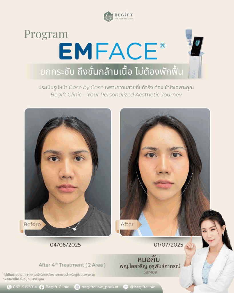 Emface นวัตกรรมยกกระชับใบหน้าใหม่ล่าสุดที่แรกที่เดียวในภูเก็ต ช่วยยกกระชับใบหน้า ลดริ้วรอย EMFACE เข้าไปกระตุ้นการทำงานของชั้นกล้ามเนื้อ ไม่เจ็บ ไม่ต้องใช้เข็ม ต้องที่ BegiftClinic คลินิกความงามภูเก็ต